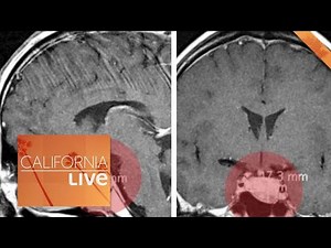 The Supplement That Helped a Doctor With His Brain Tumor | California Live | NBCLA