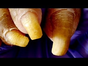 Very Long Toenails, Fungus Removal, Onychomycosis【Pedicure King】