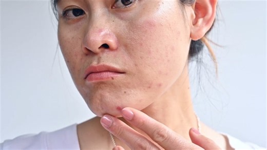 Is Your Acne Itchy? Here's What It Means—and How to Deal