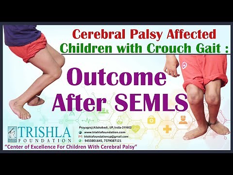 Cerebral Palsy Affected Children with Crouch Gait : Outcome After SEMLS | Trishla Foundation
