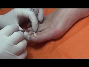 Αποκατάσταση νυχιού μετά από χειρουργική αφαίρεση(Ορθονυχία-Ονυχοκρύπτωση)