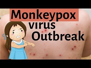 Monkeypox virus outbreak | What is monkeypox virus?