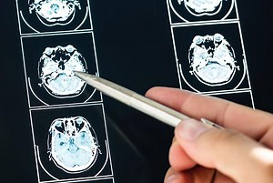 Studying how to monitor and treat TBI - UW Medicine | Newsroom