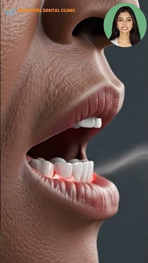 Why Impacted Wisdom Teeth Need Removal | Dr. Medapati Divya | Immanuel Dental Clinic