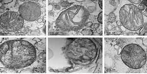 When things go wrong with mitochondria