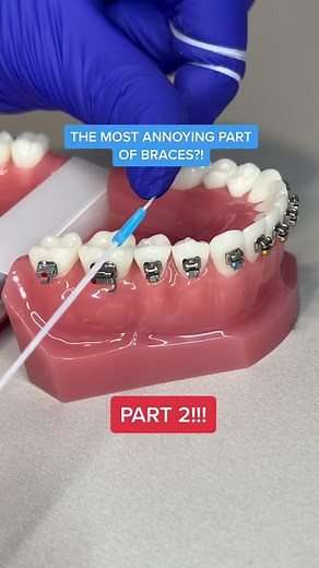 Braces Separators: The Annoying Truth