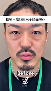 皮肤松弛＋脂肪膨出＋肌肉老化形成的眼袋 【休息、敷眼、按摩都不会消失】 摸起来还会偏硬、显老又显疲惫。 💎 Vlife 精雕祛眼袋 ✓ 一个价钱，不用配套 ✓ 一次修复，淡化约 80% 眼袋 ✓ 不动刀、不填充、自然更年轻 📩 不确定自己是哪种眼袋？发张照片，我帮你快速判断！ 👉 点击 WhatsApp： https://wa.me/60166107689?text=我想了解精雕祛眼袋 | VLIFE 眼袋专家
