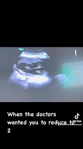 Not only did they want us to reduce for no reason at all but they also wanted us to reduce babies c and d which turned out to be our girls. So grateful that our trust and faith in God was stronger.. #fyp#quads#quadruplets#family#multiples#explorepage | Ronjera Abrahams