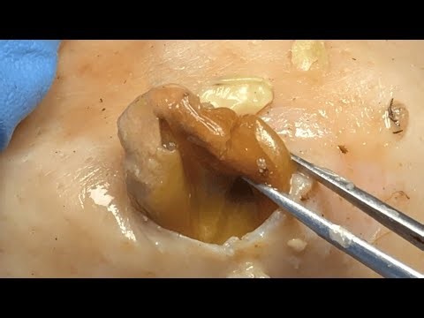 TLC #采耳哥 | cystic acne popping blackheads |Giant Boogerswax #Satisfying 825074523