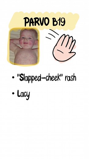 Pediatric Rashes — See the Pattern, Get the Points Measles (Rubeola): Koplik spots → cranial-to-caudal maculopapular rash 3 C’s (cough, coryza, conjunctivitis). Scarlet Fever (GAS): Sandpaper rash, strawberry tongue, circumoral pallor (± Pastia lines). Parvovirus B19: Slapped-cheek → lacy reticular body rash; pregnancy = hydrops risk. Roseola (HHV-6/7): High fever first, then trunk rash when fever resolves. Varicella: Vesicles in multiple stages (“dew-drop on a rose petal”), often central → peri