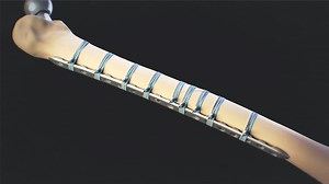 FiberTape® Cerclage for Periprosthetic Femur Fracture