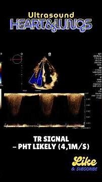 Measuring sPAP in TTE #echocardiography #pulmonaryhypertension #sPAP
