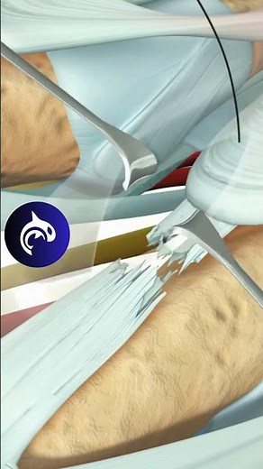 See how an Extensor Tendon Injury (Zone 4) is surgically repaired in 4K 3D animation.