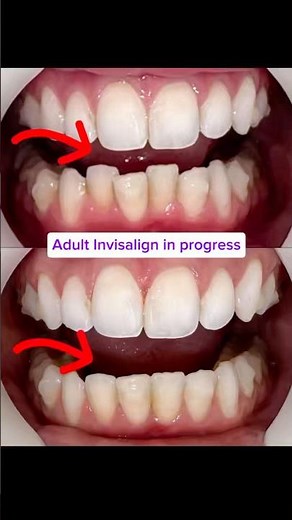Adult Invisalign Progress: Lower Teeth Straightening Before and After Results