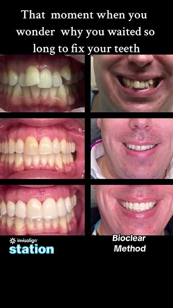 #invisalign #bioclear #veneers #invisalignsmile #smilemakeovers #smilemakeover #smiledesign #teethwhitening #bioclearmethod #biocleardoctor #bioclearmontreal #montrealdentist