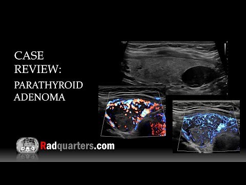 Ultrasound of Parathyroid Adenoma