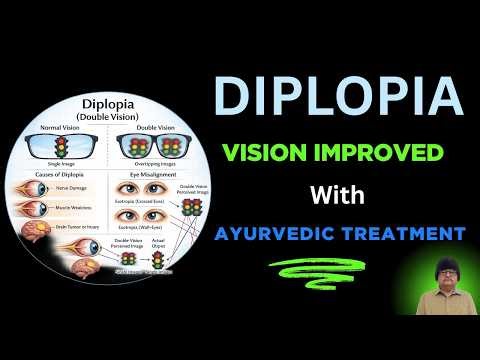 Double Vision (Diplopia) Patient Review | Ayurvedic Treatment At Om Ayurveda Eye Care Centre