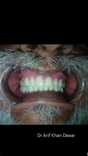 Complete Lower and upper partial denture prosthodontics #youtubeshorts #dentist #smile