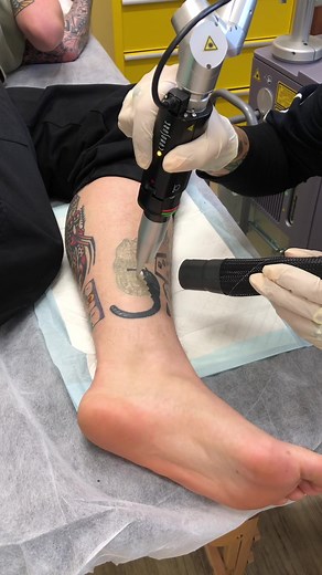 Real Time Laser Tattoo Removal Process | Swift Tattoo Removal Melbourne