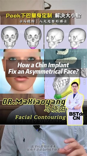 💐 How Chin Implant fix an Asymmetrical Face?大小脸可以通过假体下巴改善，中国三甲医生推荐！ 👨🏻‍⚕️：Dr.马晓阳 👌Excellent At：Chin augmentation丨隆颏/垫下巴 📍：北京🇨🇳丨北京八大处整形医院 Specialist丨主治医师 Daily updates on China’s top doctors& aesthetic trends ! #asymmetricalface #chinimplant #peek #大小脸 #peek假体下巴 #垫下巴 #隆颏 #幼态脸 #医美
