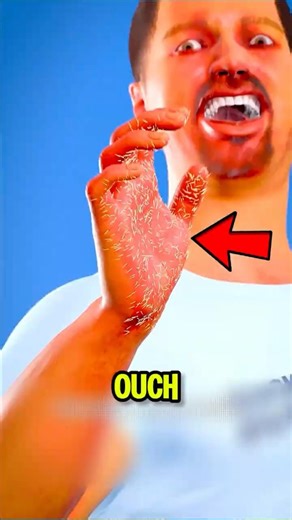 How to Remove Cactus Spines Safely 🌵