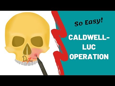 Caldwell-Luc Operation | ORAL SURGERY ‪@khanacademy‬