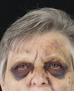 Equimosis periorbitaria ocasionada por Amiloidosis sistémica.🧐👌 Conoces otras causas?🤔 Pasión Médica | Pasión Médica