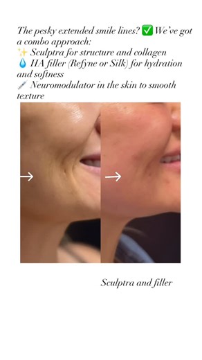 Michelle Jones| Aesthetic Medicine/San Francisco/Burlingame on Instagram: "✨ Ready to refresh your smile lines? ✨ Here’s how to book your consult: 📞 Call 650-825-4100 💻 Or book online at SkinSpirit Burlingame We’ll create a custom plan just for you with: 💉 Sculptra for structure & collagen 💧 HA filler (Refyne or Silk) for hydration 🩹 Neuromodulator in the skin for texture Let’s make it happen! 💖 650-825-4100"