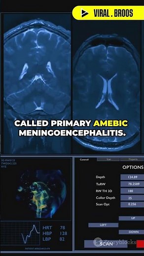 Deadly Brain-Eating Amoeba: What You Need to Know!