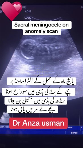 Sacral Meningocele: Anomaly Scan Findings