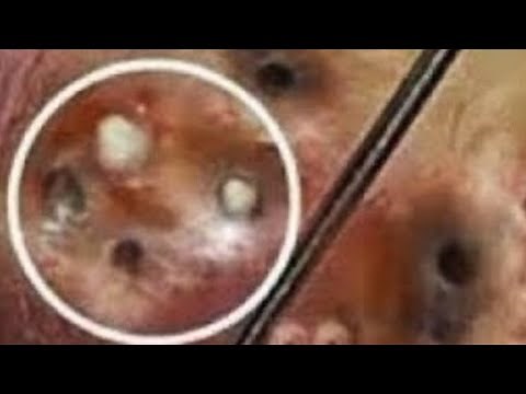 Deep blackhead extraction Cystic acne & pimple popping #33