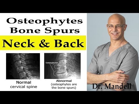 Do Bone Spurs/Osteophytes in Neck & Back Go Away? - Dr Alan Mandell, DC