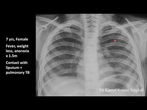 Miliary Tuberculosis