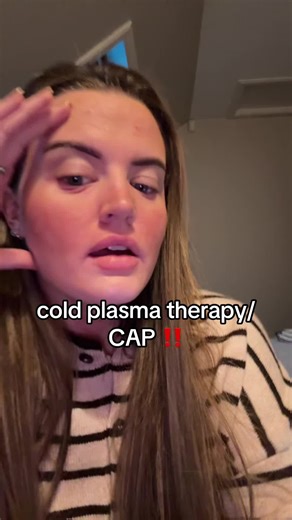 if you’ve had cold plasma/CAP therapy in Scotland for eczema please let me know !!! #CAP #coldplasma #cryotherapy #eczema #tsw