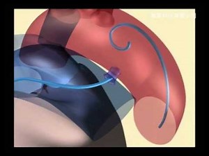 AMPLATZER Duct Occluder(PDA)