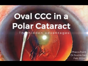 How performing an Oval CCC in Polar cataracts Helps