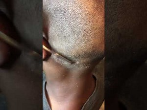 Dandruff After A Fresh Haircut