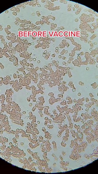 Blood Under Microscope: Before vs After Vaccine