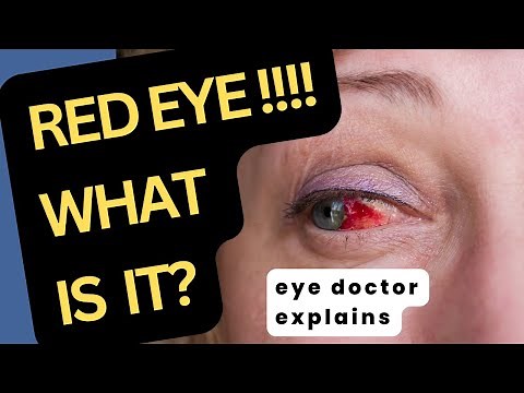 Sudden BLOODSHOT Eye | Pain Vs No Pain | Why are my eyes bloodshot? What causes a red eye?