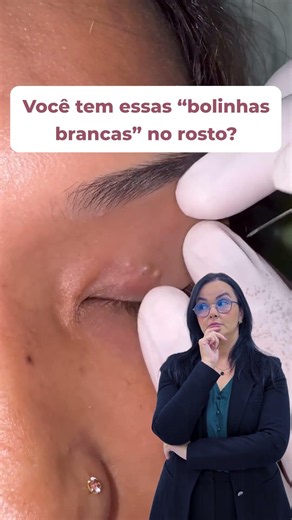Você tem essas "bolinhas brancas" no rosto?