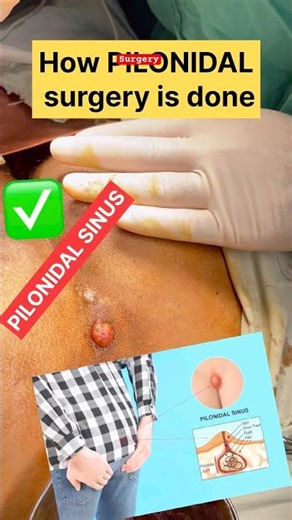 PILONIDAL sinus surgery 3d flap surgery #pilonidalsinus #surgery #medicine #healthtips