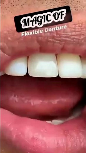 Flexible DENTURE #denturewearer #dentures #rpd #flexibledenture #keraladentist #shortsfeed #pov