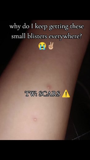 Understanding Itchy Blisters and Their Causes