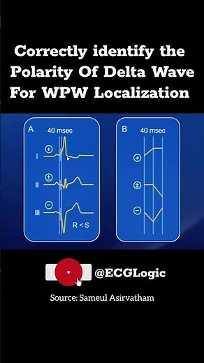 Delta Wave of WPW on ECG
