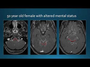 Meningeal Enhancement