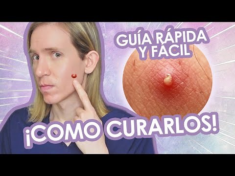 COMO TRATAR GRANITOS PUNTUALES - Con pus o internos - Guía definitiva - Simon Scarano Dermatólogo