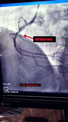 "Clearing the way:RCA Angioplasty Before and after "