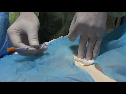 Colocación Subclavio Seldinger