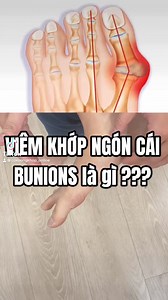 243 reactions · 49 shares | Bài tập viêm khớp ngón cái | Nguyễn Hoàng | Facebook
