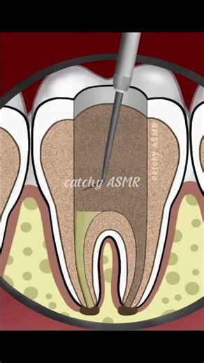 Dental decay restoration, Teeth cleaning, cavity treatment animation,#animation#trending#asmr#teeth